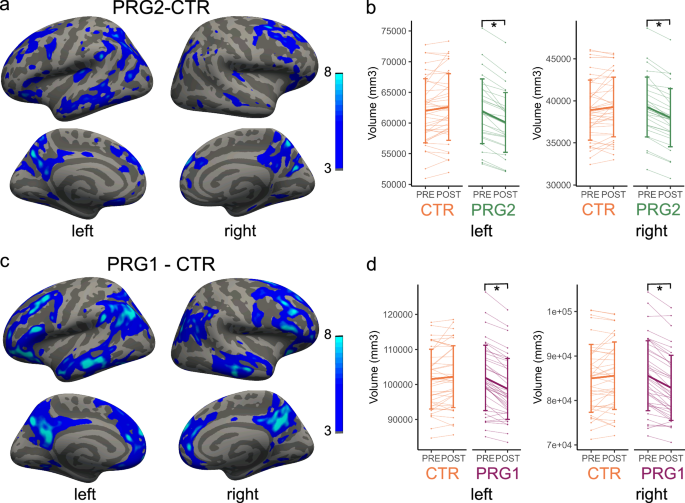 Fig. 1: Vertex-wise analysis of cortical volume change between multiparous, primiparous and control women.