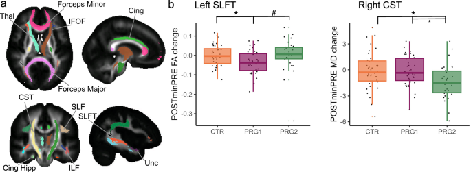 Fig. 4: Changes in white matter organization across a first and second pregnancy.