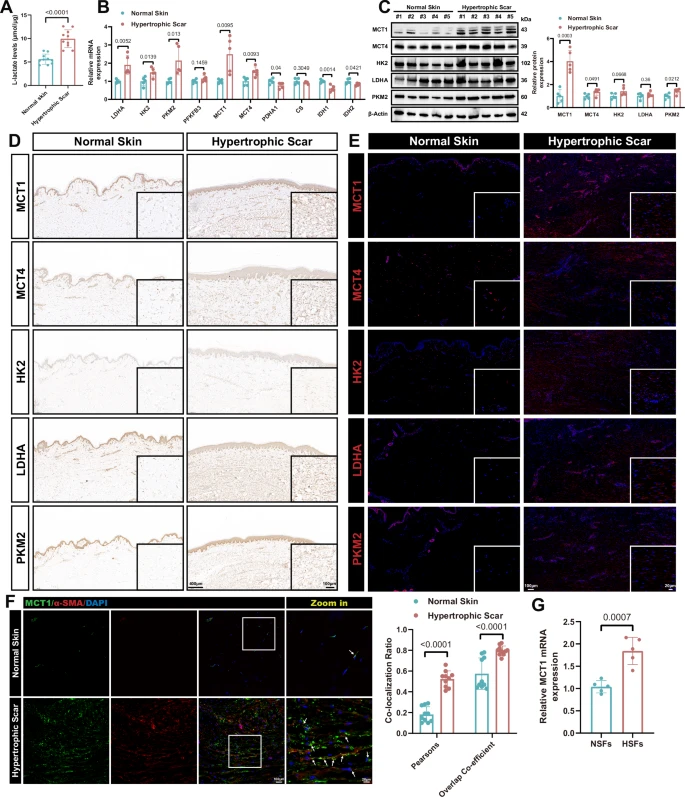 Fig. 1: Elevated glycolysis and lactate transport capacity in hypertrophic scar.