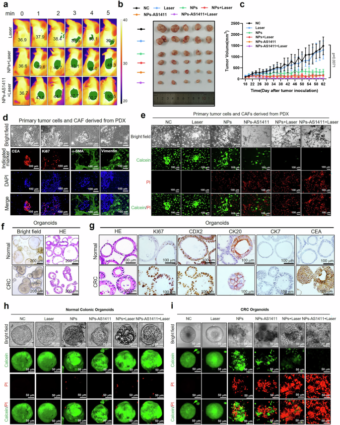 Fig. 7: Validation of the therapeutic effect of NPs in CRC patients-derived cancer models.