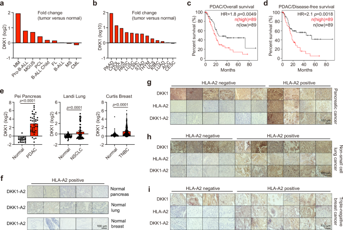 Fig. 1: Expression profiles of DKK1 and DKK1-A2 complex in human tumors and normal tissues.