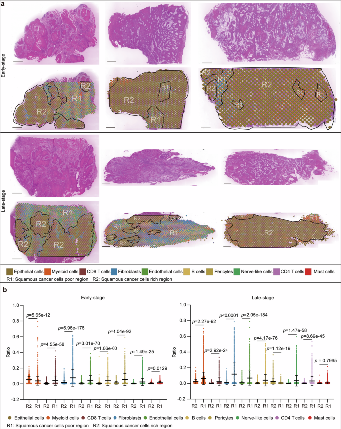 Fig. 3: Spatial transcriptome analysis reveals distinct distribution patterns of myeloid cells in early- and late-stage OSCC.