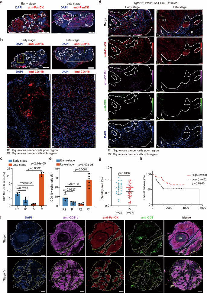 Fig. 5: MDSCs locate in non-tumor region correlated with poor prognosis of OSCC.