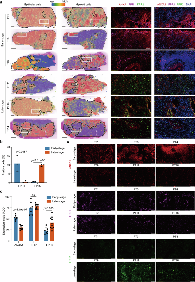 Fig. 6: The FPR1/2 positive myeloid cells have an alternated relationship to ANXA1 positive epithelial tumor cells.