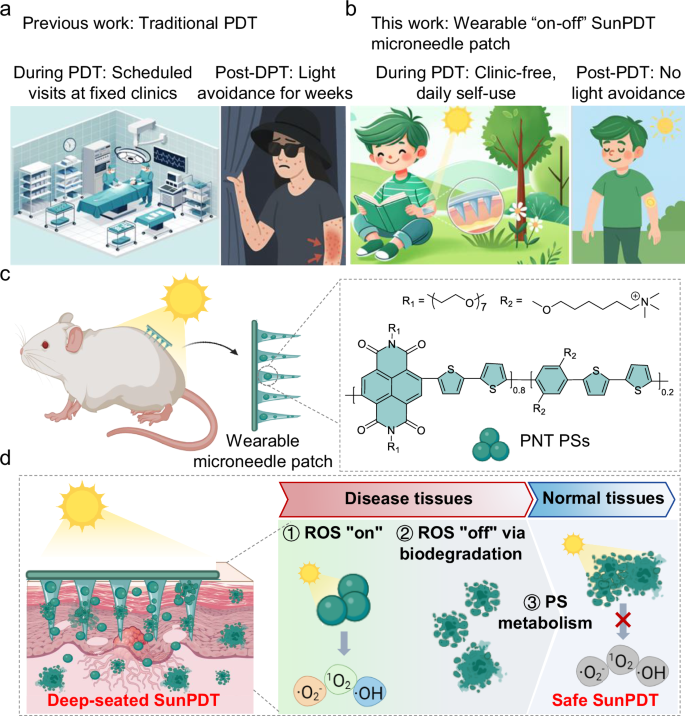 Mild-Sunlight-Activated Safe Photodynamic Therapy Using On-Off Polymer Photosensitizers in Wearable Microneedle Patch