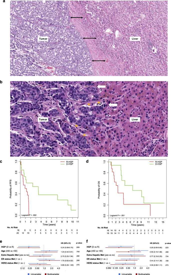 Fig. 1: Histological growth patterns in liver metastases from breast cancer patients.
