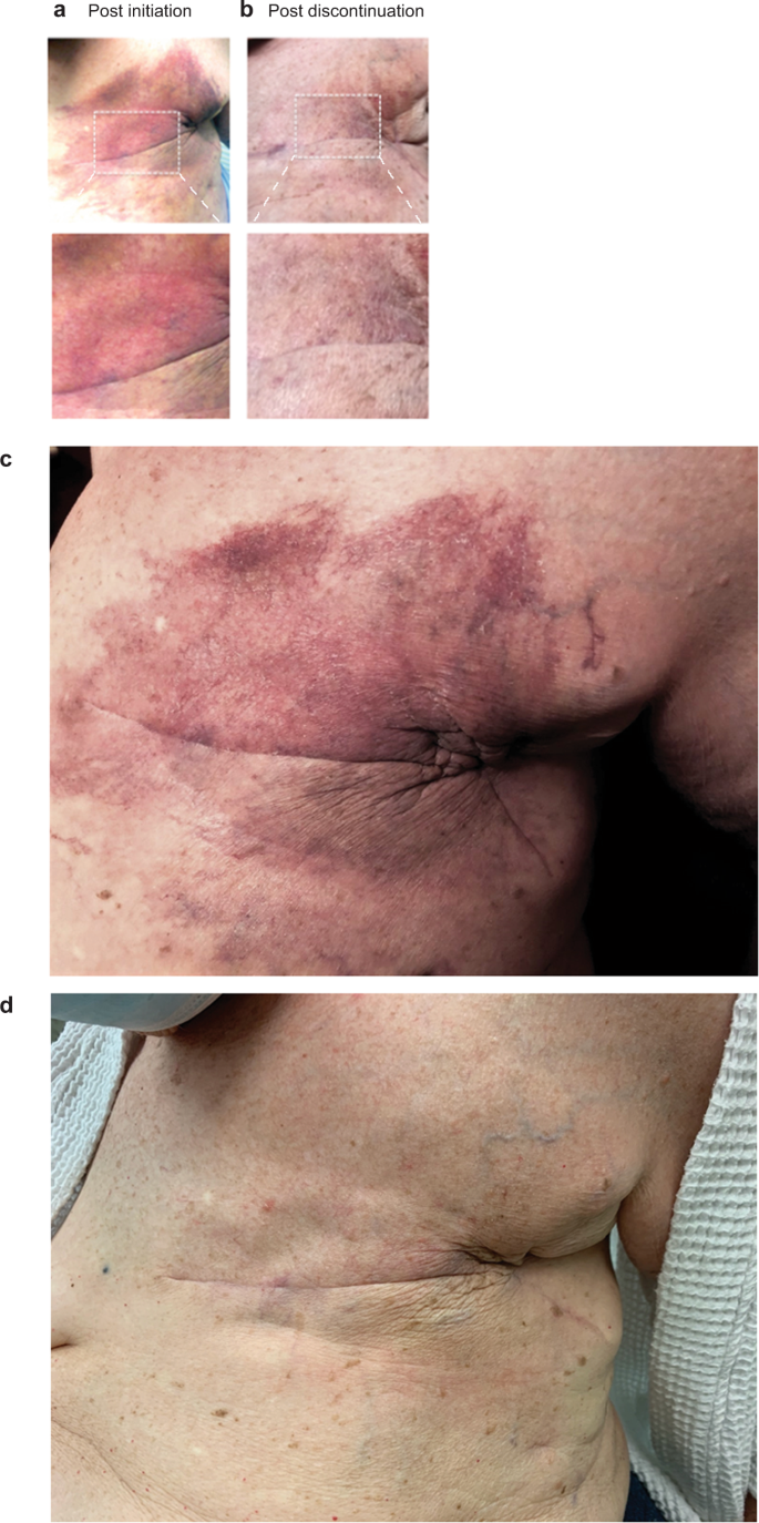 Radiation recall dermatitis following letrozole administration in patient  with a remote history of radiation therapy | npj Breast Cancer