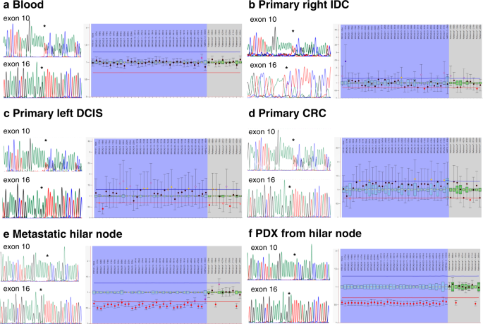 Fig. 3: Sanger sequencing and MLPA results from normal and tumor samples indicate that the c.1813dup and c.7796 A > G BRCA2 variants are in trans.