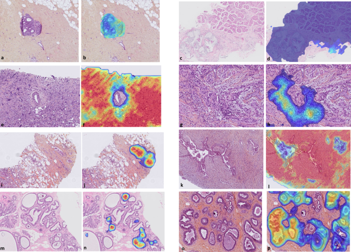 Fig. 2: Examples of tumors and benign features identified by the AI algorithm.