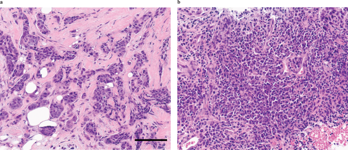 Fig. 3: Representative H&E sections demonstrating TIL percentage in breast cancer specimens.