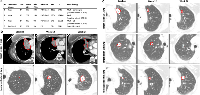Fig. 5: Outcomes in metaplastic TNBC patients.