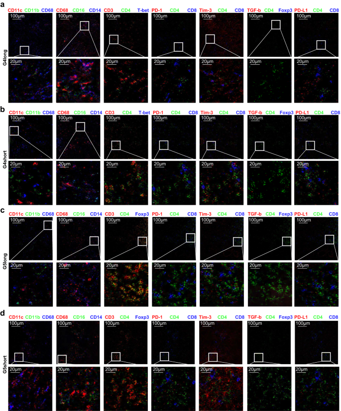 Fig. 3: The different spatial distributions of immunophenotypes in Miller-Payne 4/5 groups associated with good and poor prognosis.