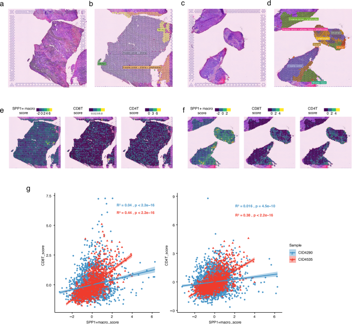 Fig. 5: SPP1+ macrophages and CD8T/CD4T are spatially colocalized in TIL-high HR+ breast cancer.