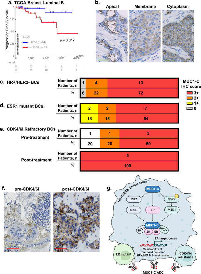 Fig. 7: Expression of MUC1-C in HR+/HER2− BCs with ESR1 mutations and refractory to CDK4/6 inhibitor treatment.