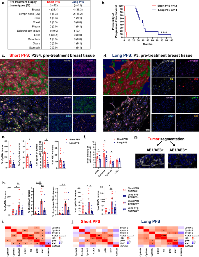 Fig. 2: Low pre-treatment tumor levels of cyclin A or E associate with long PFS.