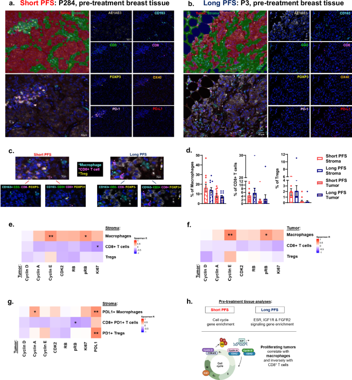 Fig. 3: Pre-treatment cyclin E+ tumors directly correlate with macrophages while cyclin A+ tumors correlate with PD-L1+ macrophages.