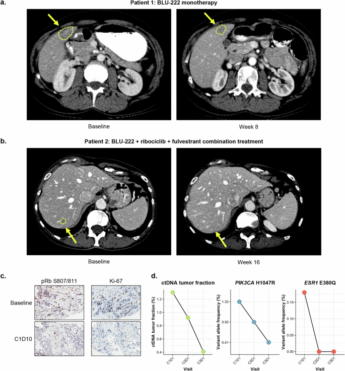 Fig. 7: Emerging BLU-222 clinical data demonstrate early evidence of activity as monotherapy or in combination with ribociclib + ET in patients with breast cancer.