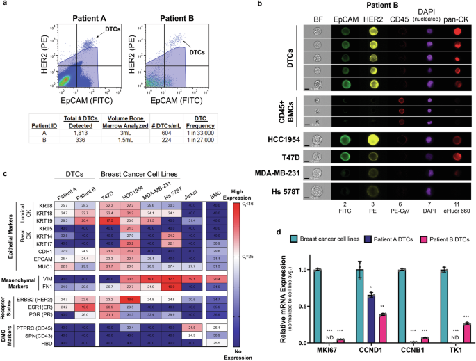 Fig. 4: Detection of bone marrow DTCs in breast cancer patients with ER+/PR+ metastatic/recurrent tumors.