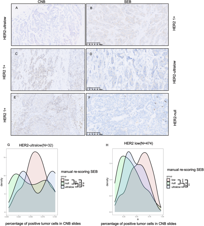 Fig. 3: HER2 status conversion between core needle biopsy (CNB) and surgical excision specimens (SEB).