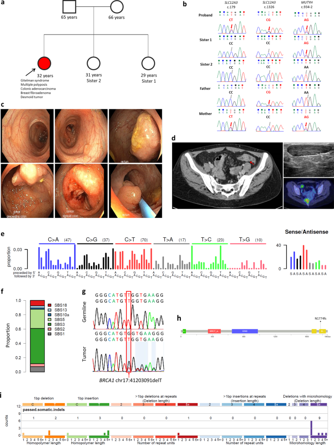 Multiple Neoplasia In A Patient With Gitelman Syndrome Harboring Germline Monoallelic Mutyh Mutation Npj Genomic Medicine