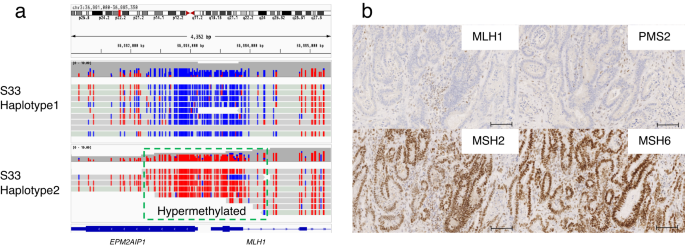 Fig. 7: A case of an MLH1 epimutation in a patient with LS.