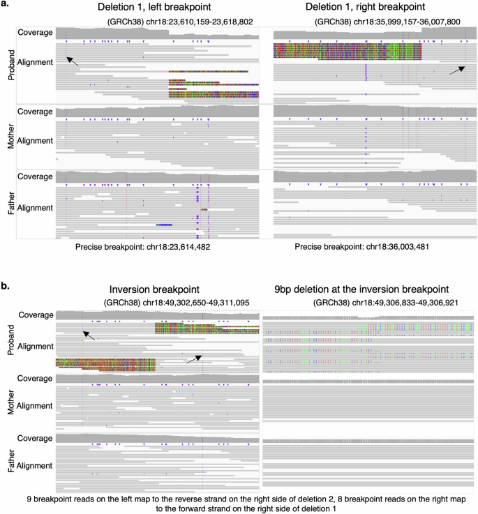 Fig. 3: PacBio circular consensus sequencing generated high-quality breakpoint spanning reads used to infer the chr18q rearrangement in family 2.