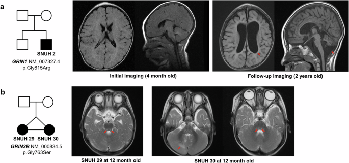 Fig. 1: Representative cases of GRIN-related neurodevelopmental disorders.