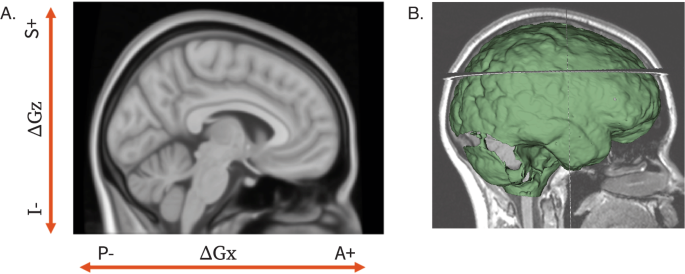 Fig. 1: Visualization of shift axis and sign indication on a template MNI brain.
