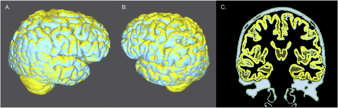 Fig. 2: 3D visualization of upward brain center of mass shift for a specific astronaut.