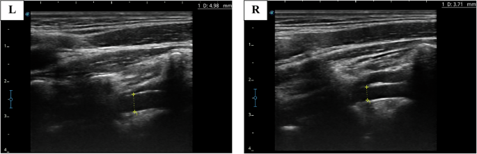 Fig. 5: Two-dimensional ultrasound image of a 31-year-old male participant with left VA dominance.