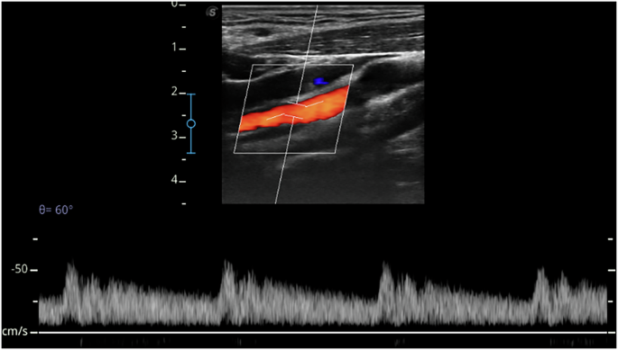 Fig. 6: Hemodynamic features of the ICA in a 21-year-old male participant.