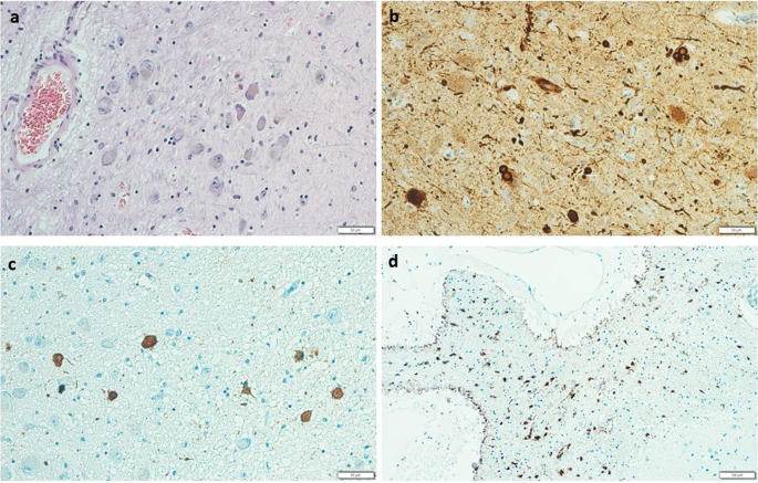 Lewy body disease or diseases with Lewy bodies? | npj Parkinson's Disease