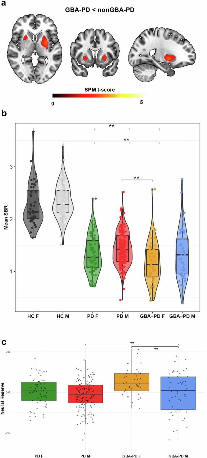 Male sex accelerates cognitive decline in GBA1 Parkinson’s disease