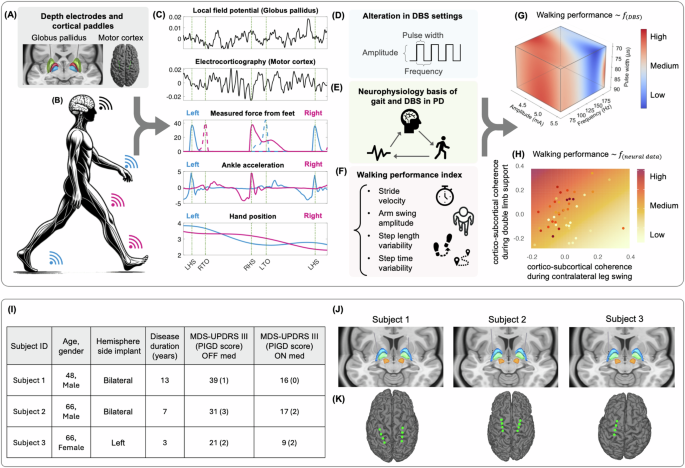 Fig. 1: Workflow overview, patient characteristics, lead reconstruction, and electrode placement.