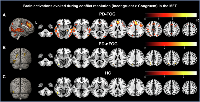 Fig. 3: Whole-brain activation patterns during the conflict effect (incongruent > congruent) for the MFT (Experiment 2).
