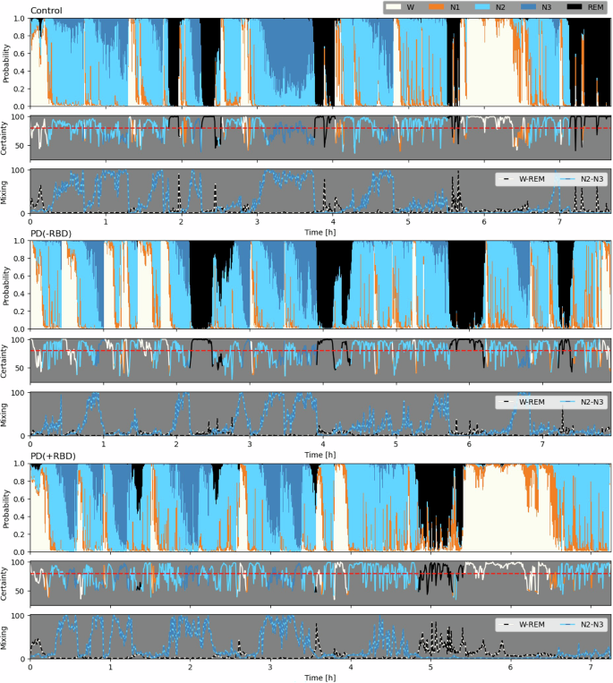 Fig. 5: Hypnodensities modeling scored by U-Sleep in a control participant, as well as in a patient with Parkinson’s Disease (PD) without rapid eye movement sleep behavior disorder (RBD) [PD(-RBD)], and a patient with PD and RBD [PD(+RBD], all being the closest to the median of their group.