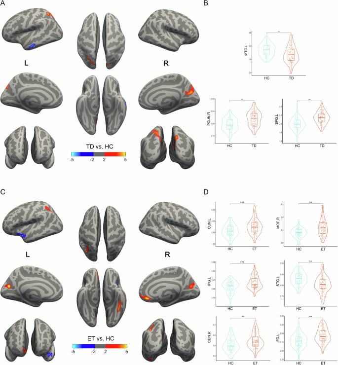 Fig. 1: The alteration of cortical thickness in TD and ET patients compared to HC.