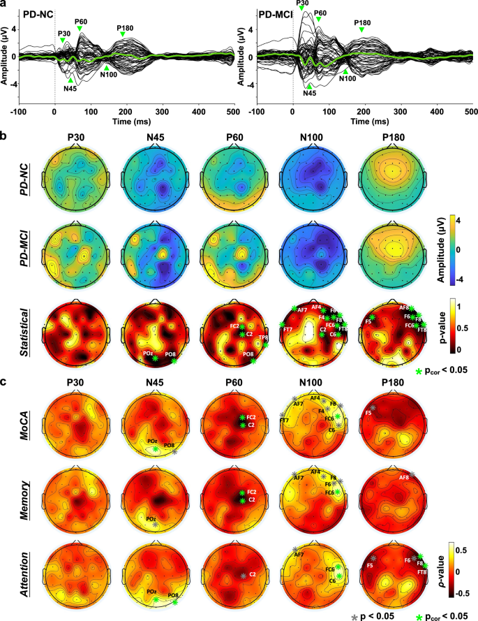 Fig. 2: Local cortical activity elicited by TMS of the right PPC and MoCA correlations.