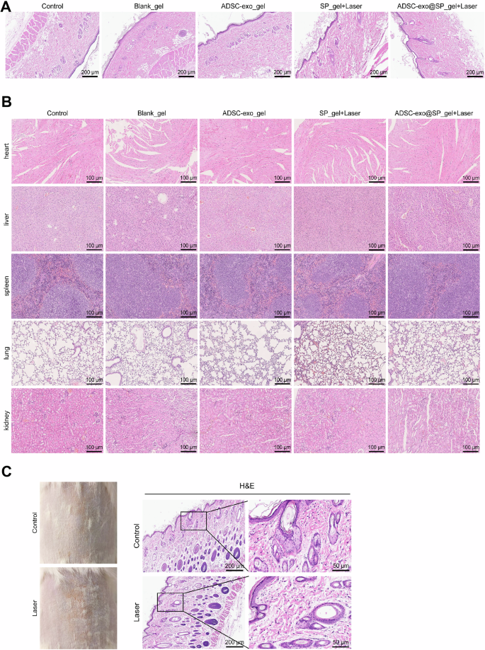 Novel approach for diabetic wound healing: adipose-derived mesenchymal  stromal cells Exo@SPHydrogel combined with laser therapy