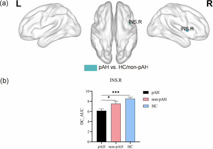 Fig. 2: One-way ANCOVA of the AUC for degree centrality.