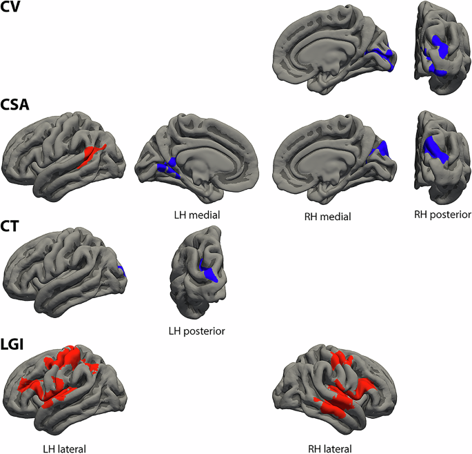 Fig. 1: Clusters of different cortical morphological measures associated with the positive formal thought disorder dimension.