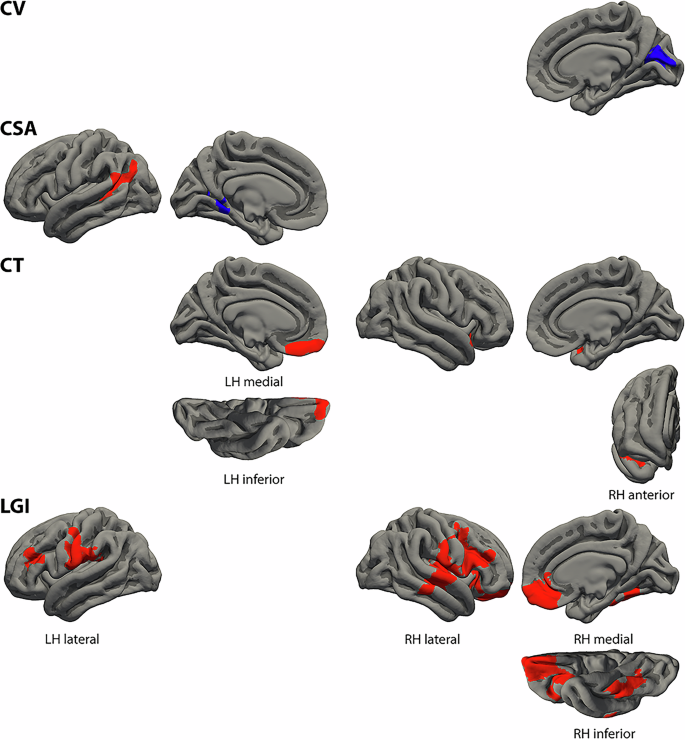 Fig. 2: Clusters of different cortical morphological measures associated with the linguistic control formal thought disorder dimension.