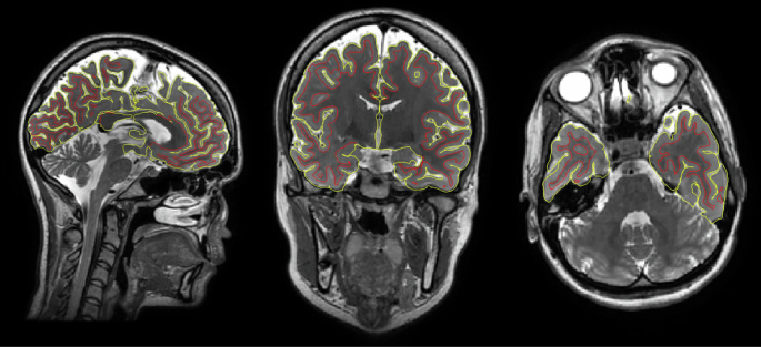 Fig. 1: Shows example MRI volumes.