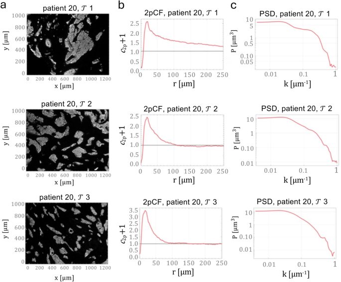 Fig. 3: Spatial statistical analysis of patient biopsy tissues.