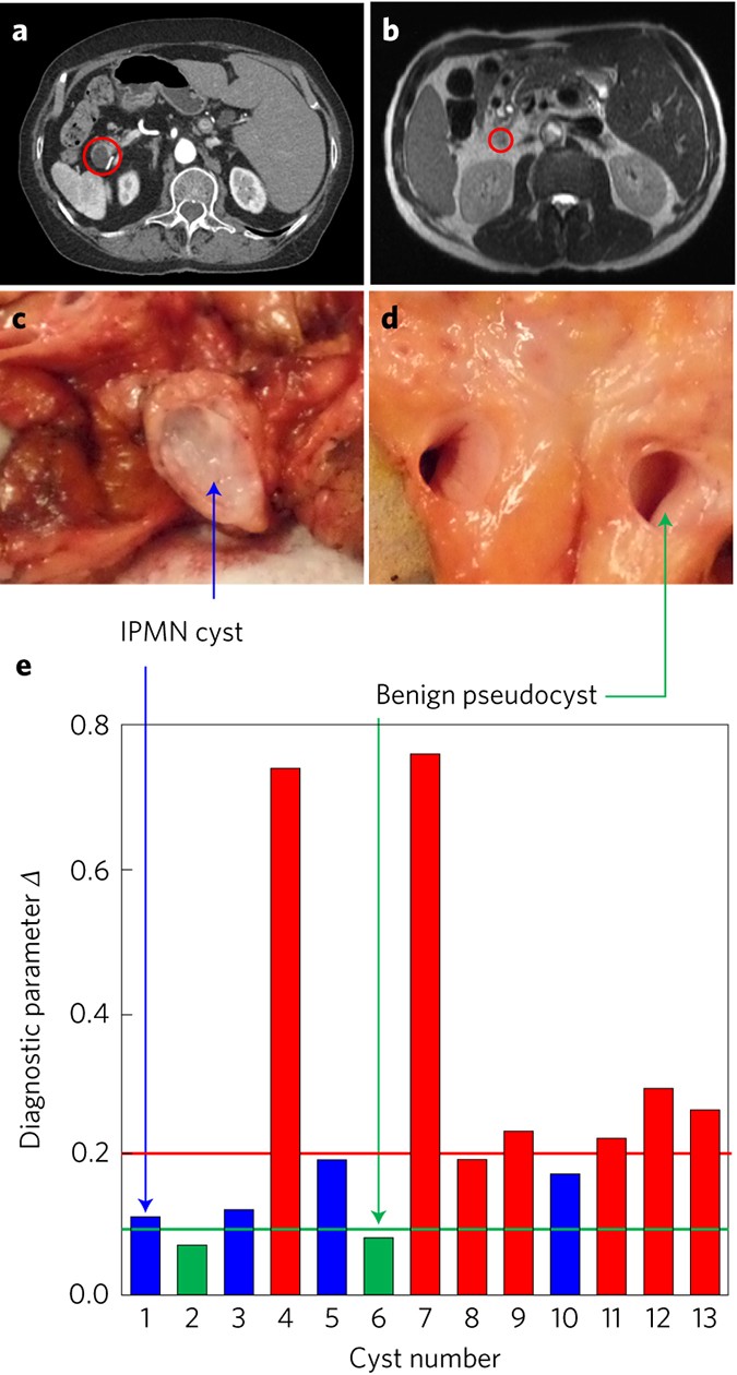Light Scattering Spectroscopy Identifies The Malignant Potential Of Pancreatic Cysts During Endoscopy Nature Biomedical Engineering Light Scattering Spectroscopy Identifies The Malignant Potential Of Pancreatic Cysts During Endoscopy Nature Biomedical Engineering