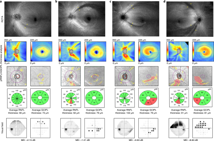 RNFL Analysis in the Diagnosis of Glaucoma - Glaucoma Today