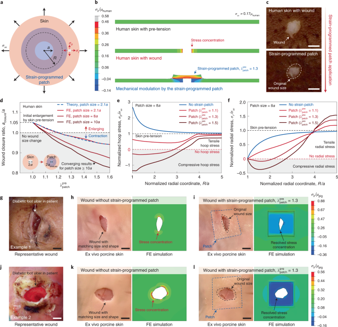 A strain-programmed patch for the healing of diabetic wounds | Nature  Biomedical Engineering