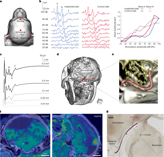 Fig. 2: Soft ABI placement and validation both intra- and post-operatively.