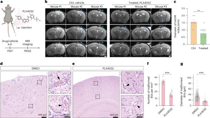 Fig. 5: Treatment of bAVM with PLX4032.