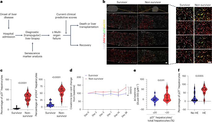 Fig. 2: Hepatocellular senescence in human severe acute indeterminate hepatitis correlates with development of subsequent renal dysfunction.